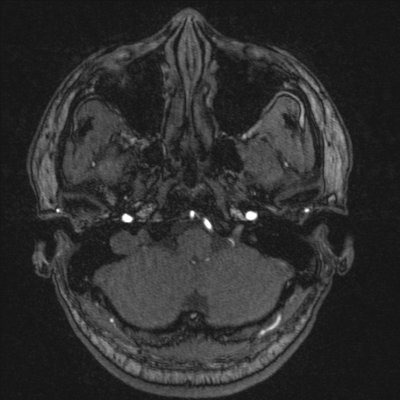Normal brain MRI including MRA (Radiopaedia 48748-53763 Axial MRA 25).jpg