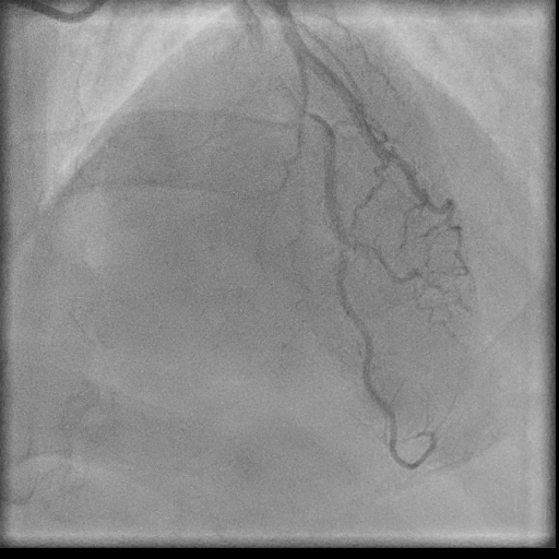 Normal coronary angiogram (DSA) (Radiopaedia 63081-71571 E 75).jpg