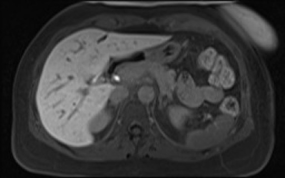 File:Normal hepatobiliary phase liver MRI (Radiopaedia 58968-66230 A 42).jpg