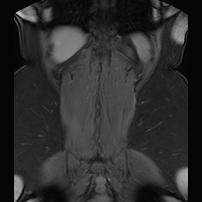 Normal liver MRI with Gadolinium (Radiopaedia 58913-66163 P 74).jpg