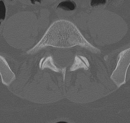 File:Normal lumbar spine CT (Radiopaedia 46533-50986 Axial bone window 60).png