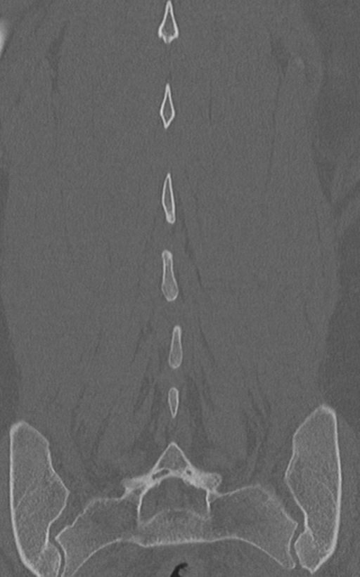 Normal lumbar spine CT (Radiopaedia 46533-50986 Coronal bone window 64).png