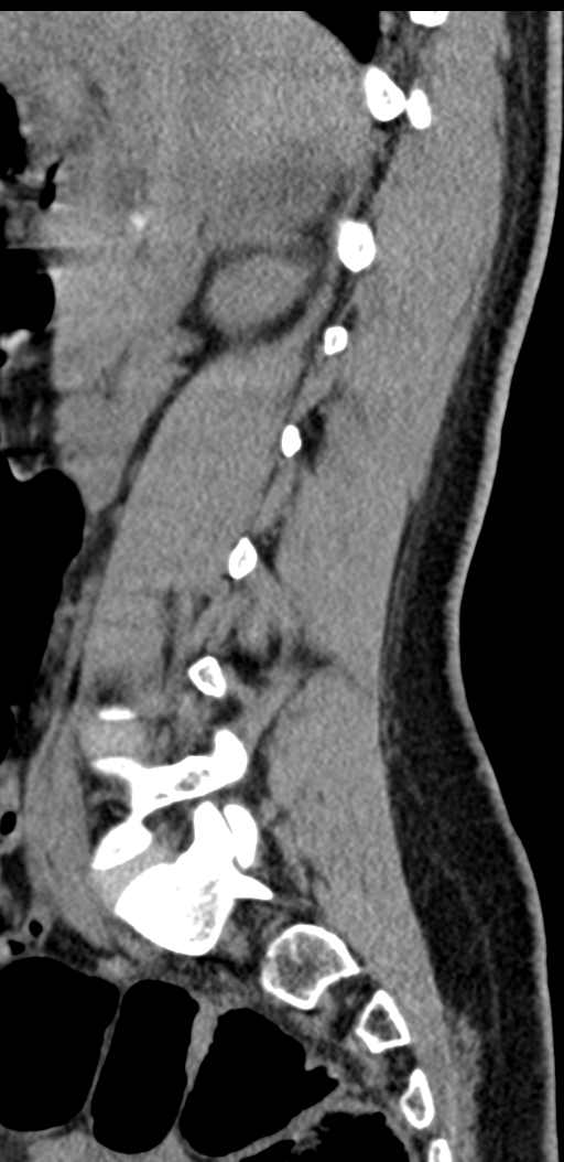 Normal lumbosacral CT (Radiopaedia 37923-39867 E 73).png