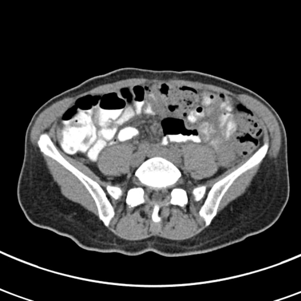 File:Normal multiphase CT liver (Radiopaedia 38026-39996 Axial non-contrast 58).jpg