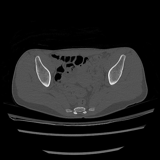 Normal pelvis CT (Radiopaedia 51471-57236 Axial bone window 55).jpg