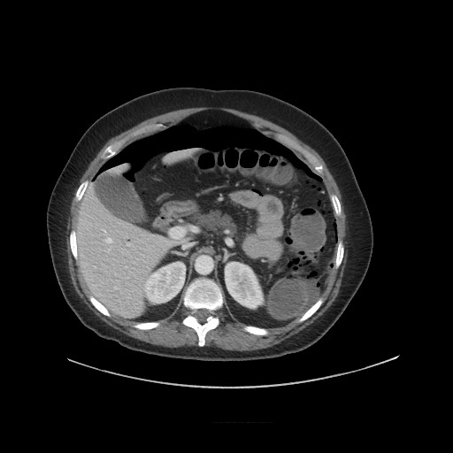 Obstructive distal colonic adenocarcinoma causing cecal perforation (Radiopaedia 86830-102989 A 61).jpg