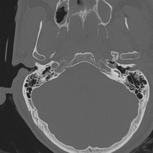 File:Occipital condyle fracture (Radiopaedia 33467-34517 Axial bone window 2).png