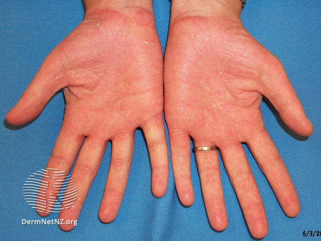 File:Psoriasis (DermNet NZ scaly-acquired-kd5).jpg