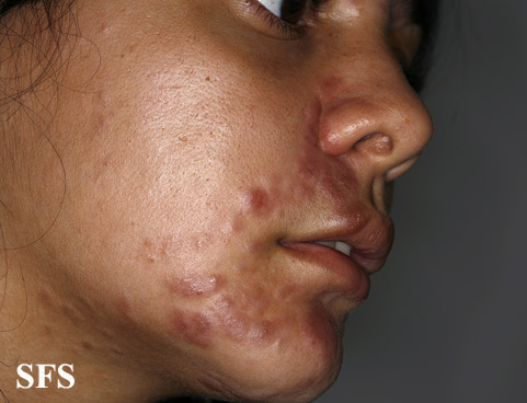 File:Sarcoidosis (Dermatology Atlas 26).jpg