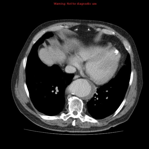 Abdominal aortic aneurysm (Radiopaedia 10122-10660 Axial C+ portal venous phase 4).jpg