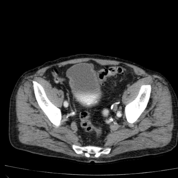 Abdominal aortic aneurysm (Radiopaedia 29248-29660 Axial C+ arterial phase 75).jpg