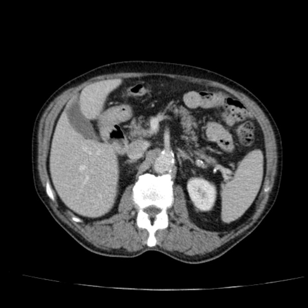 Abdominal aortic aneurysm (Radiopaedia 29248-29660 Axial C+ portal venous phase 22).jpg