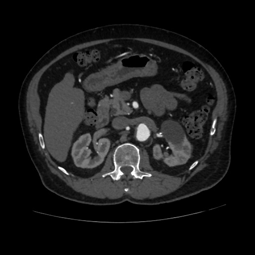 File:Abdominal aortic aneurysm (Radiopaedia 57318-64259 Axial C+ arterial phase 27).jpg