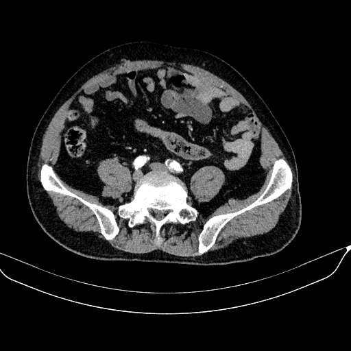 Abdominal aortic aneurysm (Radiopaedia 67117-76452 Axial C+ arterial phase 95).jpg