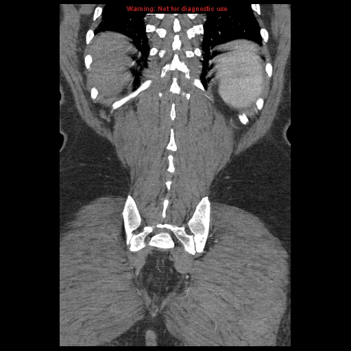 Abdominal aortic aneurysm (Radiopaedia 8190-9038 Coronal C+ arterial phase 111).jpg