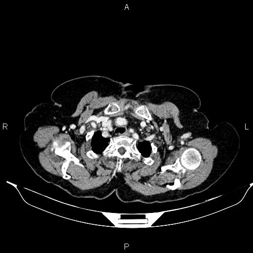 File:Abdominal aortic aneurysm (Radiopaedia 85063-100606 Axial C+ portal venous phase 7).jpg