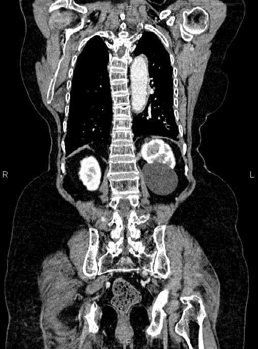 Abdominal aortic aneurysm (Radiopaedia 85063-100606 Coronal C+ arterial phase 45).jpg