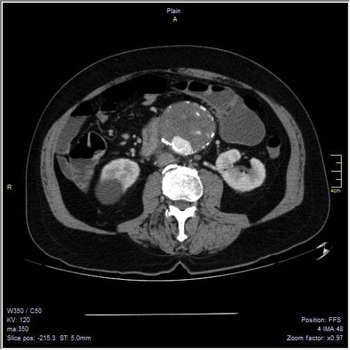 Abdominal aortic aneurysm with thrombus fissuration (Radiopaedia 47340-51926 Axial C+ arterial phase 32).jpg