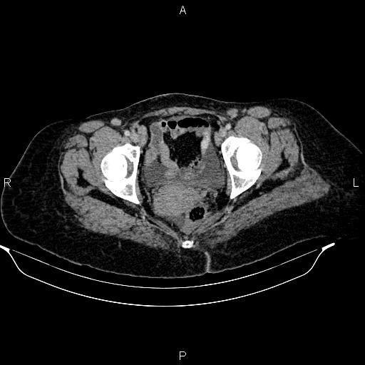 Abdominal lymphoma with sandwich sign (Radiopaedia 84378-99704 Axial C+ portal venous phase 54).jpg