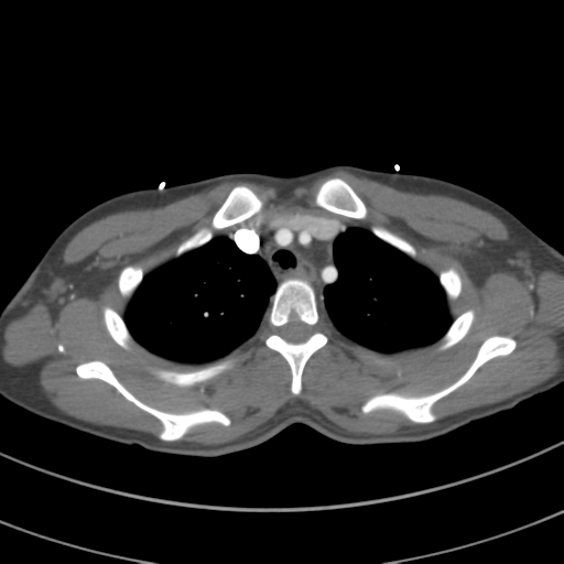 File:Abdominal multi-trauma - devascularised kidney and liver, spleen and pancreatic lacerations (Radiopaedia 34984-36486 Axial C+ arterial phase 20).png