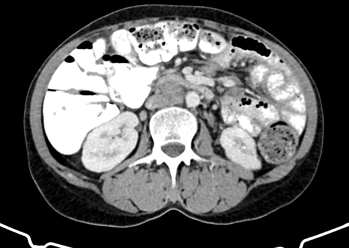 Abdominal wall and retroperitoneal tuberculosis (Radiopaedia 88137-104729 Axial C+ portal venous phase 90).jpg