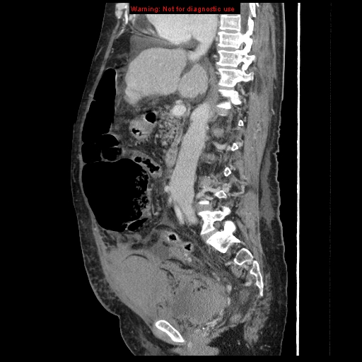 Abdominal wall hematoma (Radiopaedia 9427-10112 Sagittal C+ portal venous phase 58).jpg