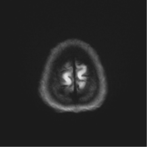 File:Abducens nerve palsy (Radiopaedia 51069-56648 Axial DWI 53).png