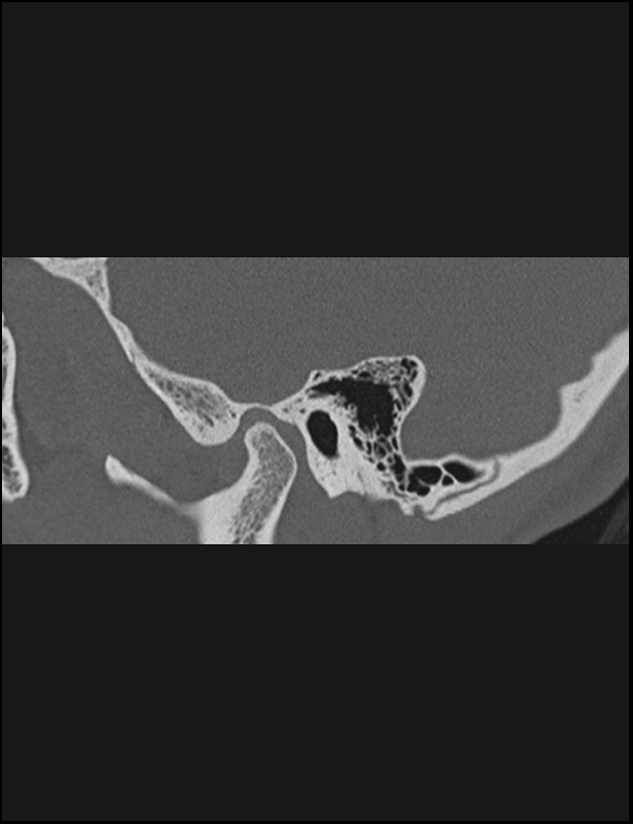 Aberrant right internal carotid artery (Radiopaedia 65191-74198 Sagittal non-contrast 36).jpg