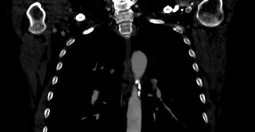 Accesory rib joint (Radiopaedia 71987-82452 Coronal bone window 3).jpg