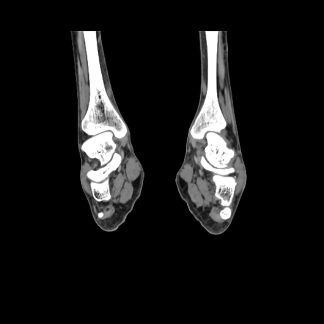 Accessory soleus muscle (Radiopaedia 61069-68943 Coronal non-contrast 39).jpg