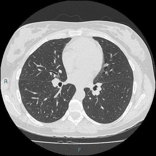 Accidental foreign body aspiration (seamstress needle) (Radiopaedia 77740-89983 Axial lung window 35).jpg