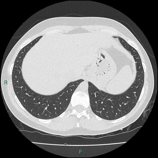 Accidental foreign body aspiration (seamstress needle) (Radiopaedia 77740-89983 Axial lung window 57).jpg