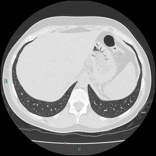 File:Accidental foreign body aspiration (seamstress needle) (Radiopaedia 77740-89983 Axial lung window 60).jpg