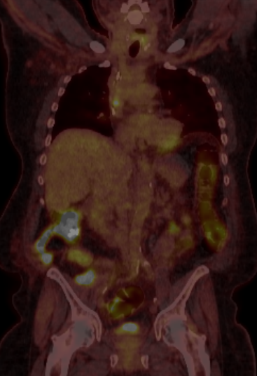 File:Accumulation of FDG in central venous catheter mimicking lymph node metastasis (Radiopaedia 63301-71878 Coronal fused PET-CT 1).PNG