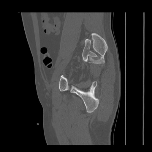 Acetabular and ilial fractures (Radiopaedia 59084-66378 Sagittal bone window 67).jpg
