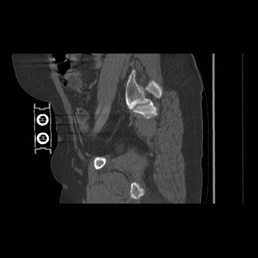 File:Acetabular fracture (Radiopaedia 13193-13212 Sagittal bone window 32).jpg
