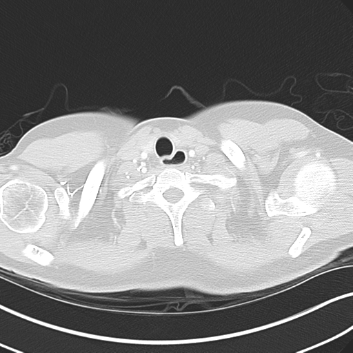 File:Achalasia of the cardia (Radiopaedia 38497-40595 Axial lung window 3).png