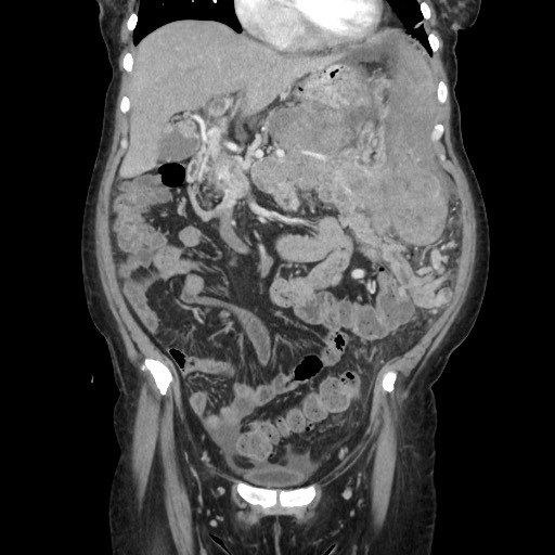 File:Acinar cell carcinoma of the pancreas (Radiopaedia 75442-86669 Coronal C+ portal venous phase 45).jpg
