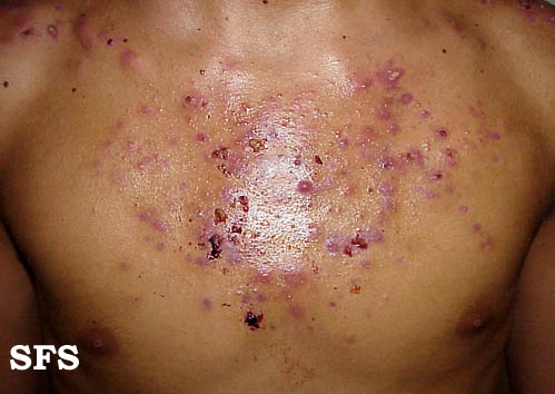 File:Acne (Dermatology Atlas 8).jpg
