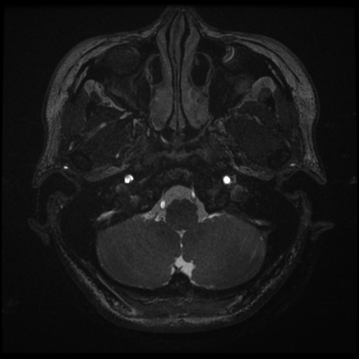 Acoustic neuroma (Radiopaedia 34049-35283 Axial 11).png