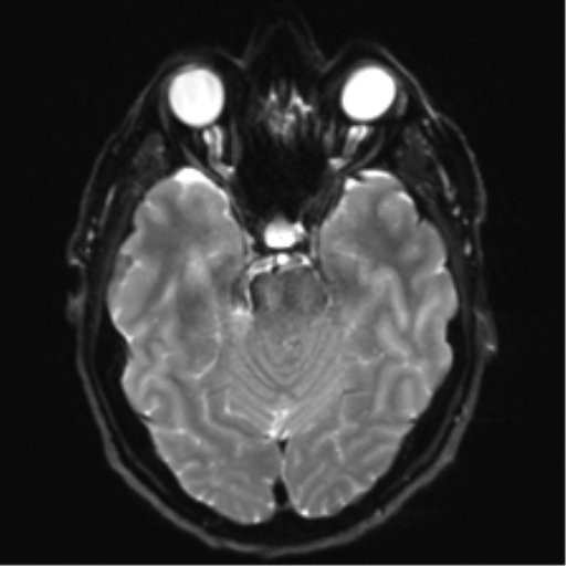 Acoustic schwannoma (Radiopaedia 50846-56358 Axial DWI 10).png