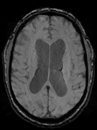 Acoustic schwannoma (Radiopaedia 55729-62281 Axial SWI 31).png