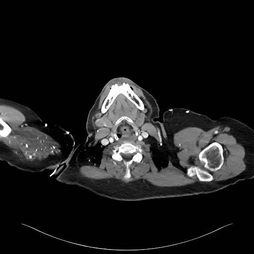Acromioclavicular joint cyst (Radiopaedia 58455-65610 Axial C+ arterial phase 6).jpg