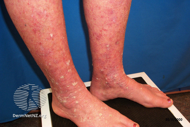 File:Actinic keratoses affecting the legs and feet (DermNet NZ lesions-ak-legs-448).jpg