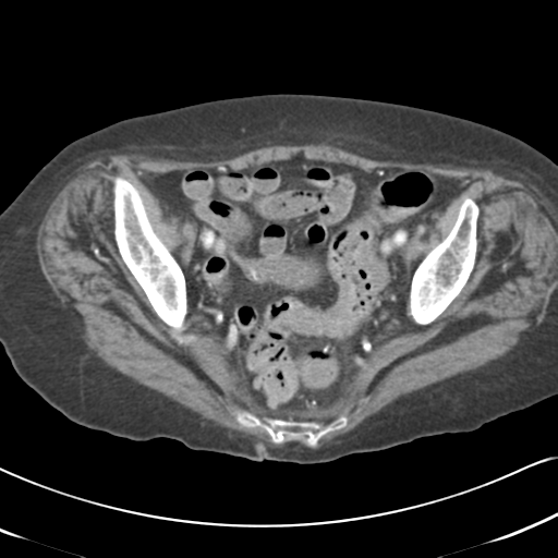 Active bleeding from duodenal ulcer with embolization (Radiopaedia 34216-35481 C 55).png