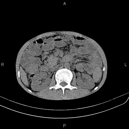 Active crohn disease (Radiopaedia 87133-103397 Axial non-contrast 41).jpg