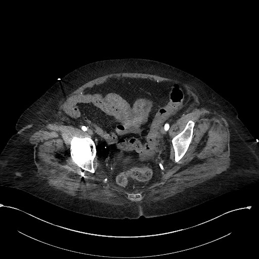 File:Active renal extravasation with large subcapsular and retroperitoneal hemorrhage (Radiopaedia 60975-68796 Axial C+ arterial phase 172).jpg