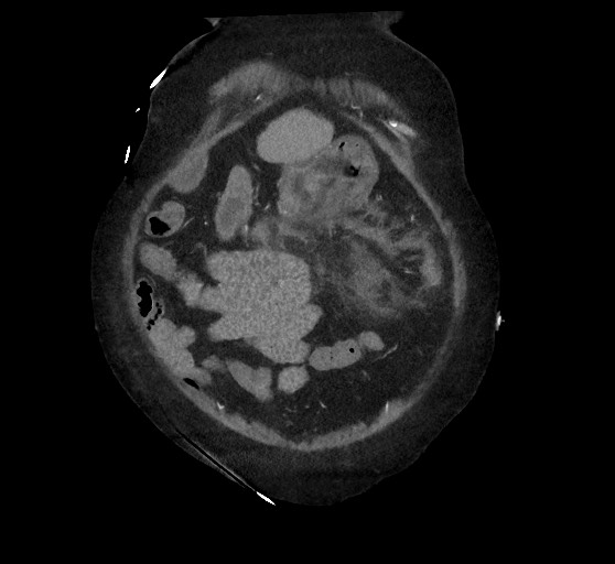 Active renal extravasation with large subcapsular and retroperitoneal hemorrhage (Radiopaedia 60975-68796 Coronal C+ arterial phase 33).jpg