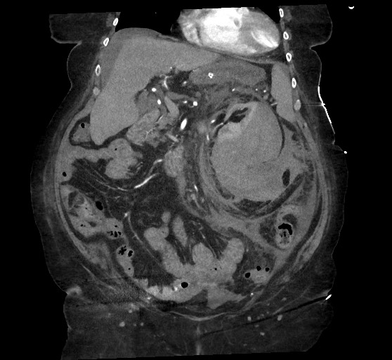 Active renal extravasation with large subcapsular and retroperitoneal hemorrhage (Radiopaedia 60975-68796 Coronal C+ arterial phase 62).jpg
