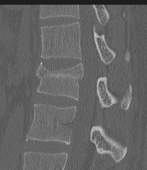 Acute L1 burst compression fracture (Radiopaedia 34430-35755 Sagittal bone window 36).png
